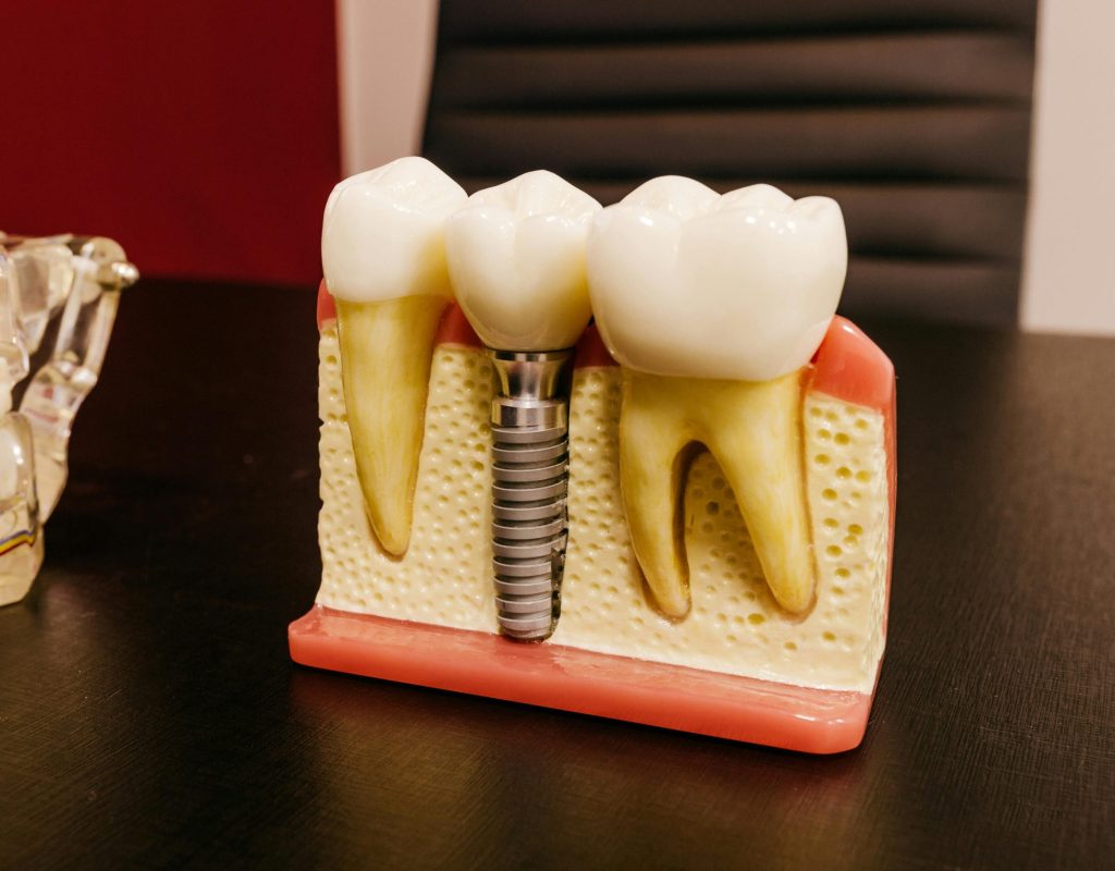 pexels photo 4687905 4687905 Close-up of a dental implant model on a professional workspace desk.